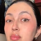 静脉曲张女达人