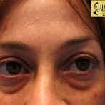 doctor الإنتفاخات تحت العين 