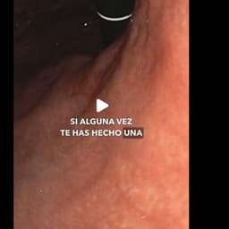 音频克隆 La GASTRITIS AGUDA es una inflamación